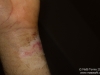 The spot I that was cut open to remove bone fragments